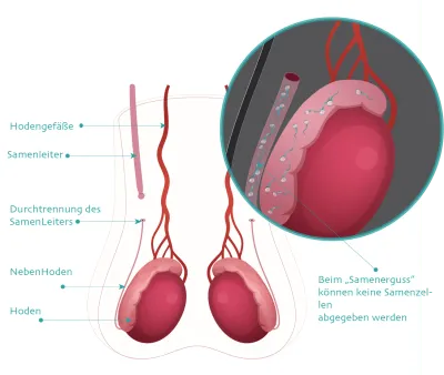 Vasektomie Illustration - Ablauf der Vasektomie beim Urologen in Wien